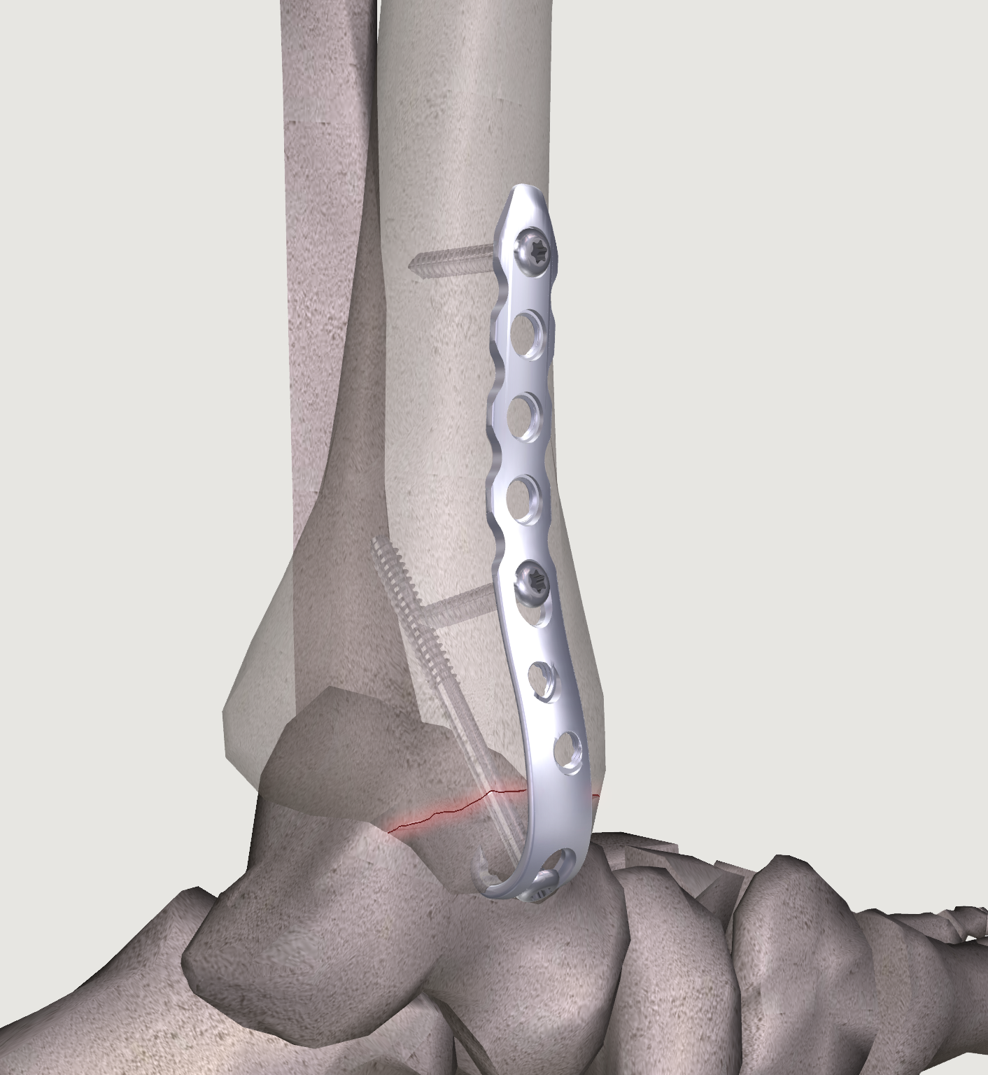 Medical - Locking Lateral Hook Plate